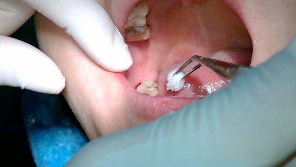 Kết quả hình ảnh cho nhổ răng khôn