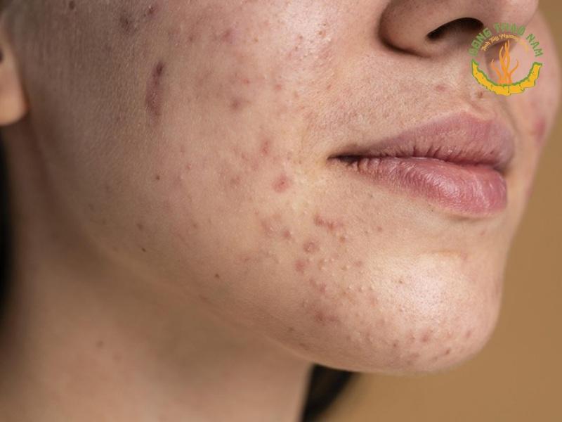 phục hồi da xỉn màu với Glutabright Skin